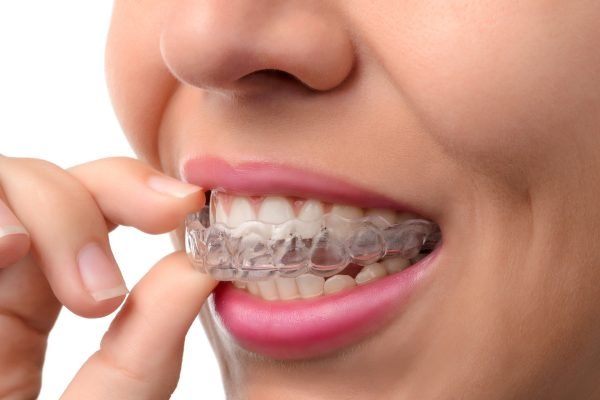 Aligner Support Solutions