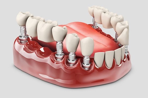 Dental Crown & Bridge Restoration.jpg
