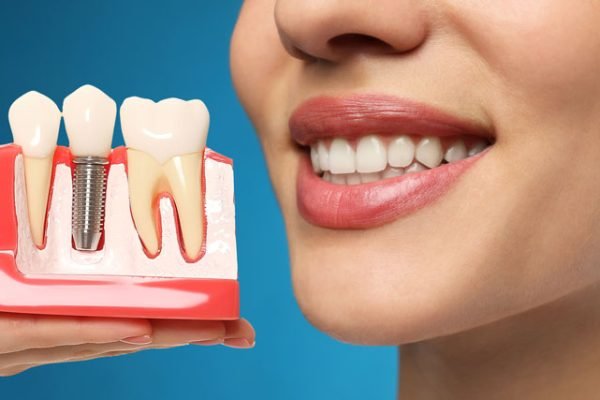 Dental Implants.jpg