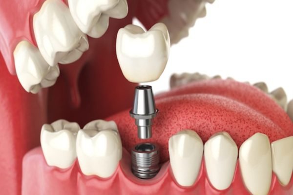 Implant Prosthetics.jpg